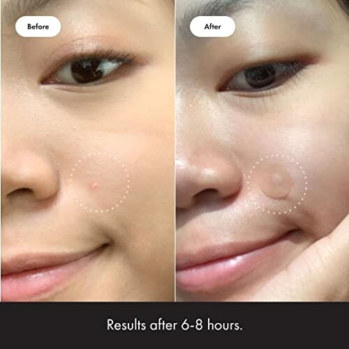 Before and after acne treatment on cheek showing improvement.