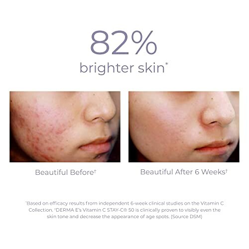 Comparison of skin before and after 6 weeks of Vitamin C treatment showing 82% brighter skin.