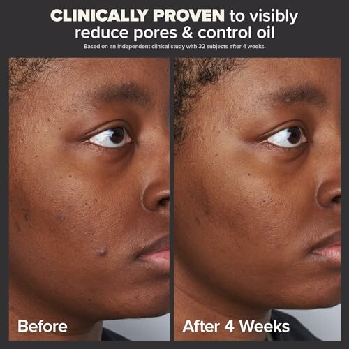 Before and after skincare comparison showing reduced pores and oil.